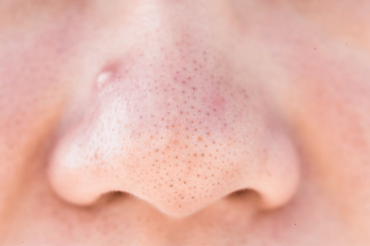How to Get Rid of Black Heads on Nose?